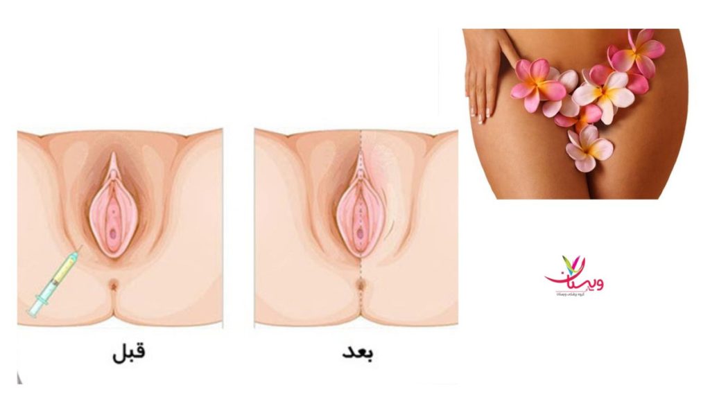 مراقبت های بعد از تزریق ژل به بیکینی+هزینه تزریق ژل به بیکینی+تنگ کننده بیکینی