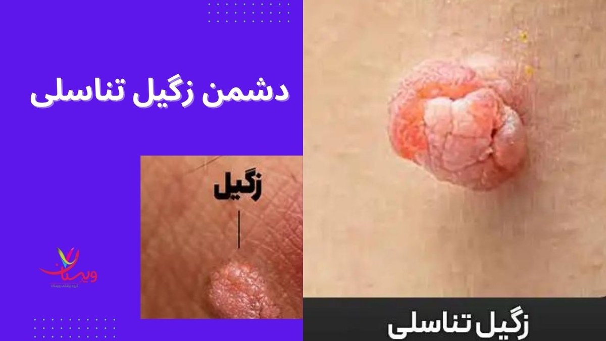 5 دشمن زگیل تناسلی + آیا خودارضایی باعث زگیل تناسلی می‌شود؟