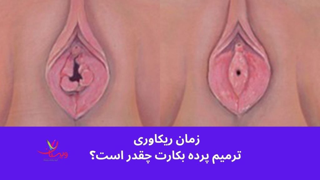 سوالات درباره ترميم بكارت هایمن